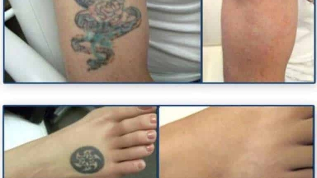 Careful Consideration About Tattoo Removal – Before And After