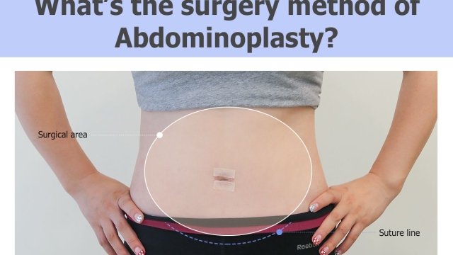 Belly Bliss: The Marvels of Abdominoplasty Revealed