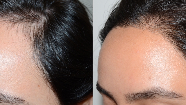 From Bald to Bold: The Implant Solution for Thicker, Fuller Hair