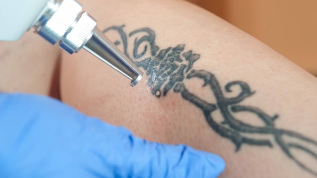 Find The Advantages And Disadvantages Of Tca Tattoo Removal